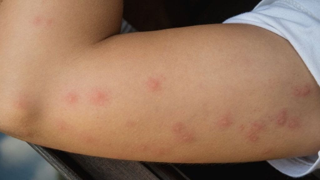 A cluster of bed bug bites along the entirety of a persons bicep. 