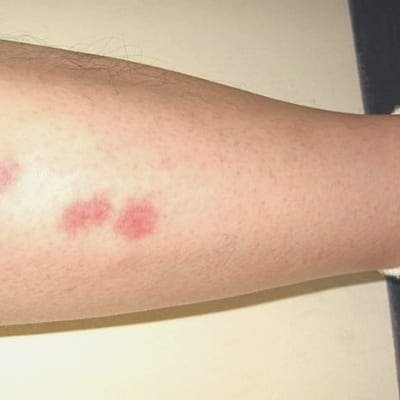 A cluster of bed bug bites on a persons leg.  
