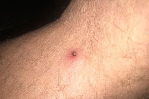 What Do Tick Bites Look Like